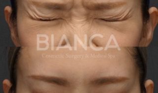 ボトックスダウンタイム期間の過ごし方を解説｜運動やお酒はいつから？